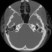 Large Vestibular Aqueduct Syndrome Radiology Reference Article Radiopaedia Org