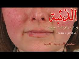 Refers to person, place, thing, quality, etc. Ø´Ø±Ø­ Ù…Ø±Ø¶ Ø§Ù„Ø°Ø¦Ø¨Ø© Ø§Ù„Ø­Ù…Ø±Ø§Ø¡ Youtube