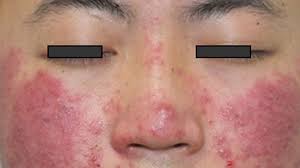 Image result for demodex rosacea