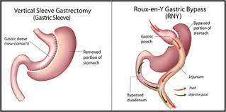 Cost of gastric sleeve (sleeve gastrectomy) surgery. Is Weight Loss Surgery For You Professor Ramos Blog