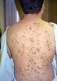 Orthopedic Manifestations Of Neurofibromatosis Type 1 (Von Recklinghausen  Disease): Background, Spinal Complications, Tibial Dysplasia