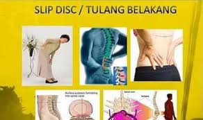 Pakar itu berkata, kebanyakan pesakit boleh dirawat dengan teknik. Rawatan Untuk Sakit Tulang Belakang Slip Disc Facebook