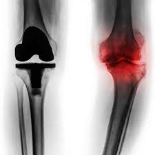 What To Expect Before During And After Total Knee Replacement Surgery Advocating For The Aging Knee Replacement Surgery Total Knee Replacement Knee Replacement