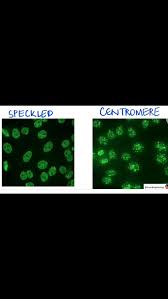 Image result for ANA Staining Pattern
