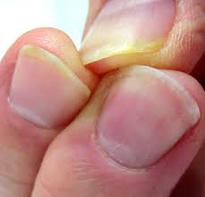 Stretch it down to the tooth on the bottom row of teeth directly under it. The Effects Of Biting Your Nails Childers Braces