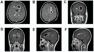 Image result for Brain Abscess