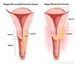 When this happens, the most common symptoms are: Cervical Cancer Treatment Pdq Treatment Patient Information Nci Cs Mott Children S Hospital Michigan Medicine