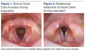Image result for Vocal Cord Dysfunction