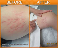 Sotradecol sclerosing agent sodium tetradecyl sulfate 1% injection 2 ml bioniche 67457016202. Sclerotherapy In New Jersey Soma Skin Laser