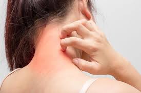 Daca afectiunea persista, in ciuda tratamentului, consultati un dermatolog. DermatitÄ Simptome Cauze Tipuri Èi Tratament
