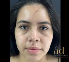 Láser Co2 en Bogotá