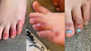 The skin lining of the oral cavity gets thickened forming lumps and reddish patches are seen here and there of the mouth. What Are Covid Toes Foot Lesions May Or May Not Be New Coronavirus Symptom Health Com