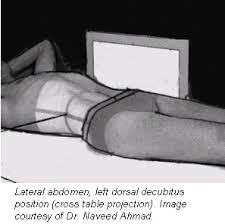 The left lateral recumbent position is also used during labor and makes uncomplicated forceps deliveries and breech births easier. Dorsal And Lateral Decubitus Patient Positioning For Abdominal X Ray Exams