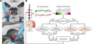 Image result for Thalamic Stimulation