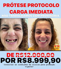 👀 Oportunidade pra você que sofre com dentaduras e NÃO PODE PAGAR MUITO  POR MES. 🔩 IMPLANTES All-on-4 PRÓTESE FIXA PROTOCOLO 🔥 🦷 Pagando POUCO  por mês no boleto Pequena entrada +