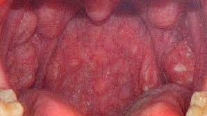 Strep Throat Symptoms Pictures Diagnosis And Treatment