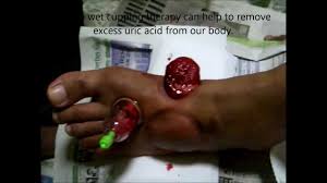 Maybe you would like to learn more about one of these? Wet Cupping Therapy Bekam Done On The Foot Of A Gout Patient Singapore Youtube