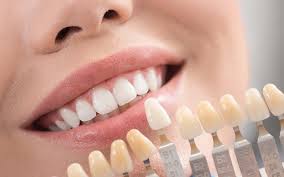 Do veneers ruin your teeth?how often do veneers need to be replaced?can veneers last 30 years?can veneers last 20 years?can veneers if the veneers are high quality and the patient cares for them properly, they can last between 15 and 30 years. E Max Laminate Veneers Magic Smile Turkey
