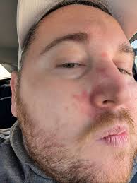 Anyone else have muscle spasms or tense muscles in one spot?