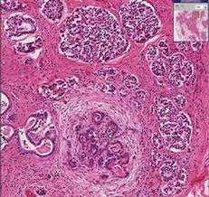 Cystic fibrosis is an inherited disease characterized by the buildup of thick, sticky mucus that can in people with cystic fibrosis, mucus often damages the pancreas, impairing its ability to produce. Histopathology Pancreas Cystic Fibrosis Youtube