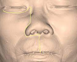 We did not find results for: Weber Fergusson Incision With Infraorbital Incision And Lip Split Incision Download Scientific Diagram