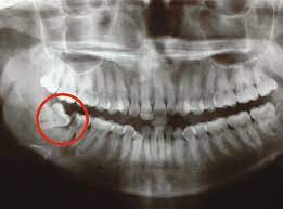 Moreover, has anyone ever had a third set of teeth? Problems With Erupting Wisdom Teeth Signs Symptoms And Management British Journal Of General Practice