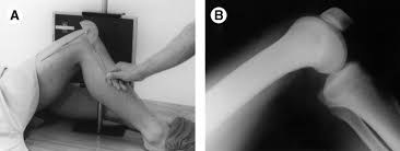Image result for PCL Sag Test