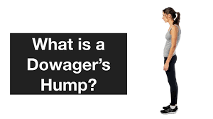 See our fully illustrated just so story books on amazon. How To Get Rid Of Dowager S Hump