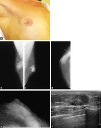 Deux à trois jours après la naissance, on peut observer chez le garçon ou la fille, une crise génitale due à la suppression brutale des oestrogènes maternels (arrêt du fonctionnement placentaire). Pathologie Du Sein Chez L Homme Sciencedirect
