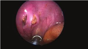 Image result for Tonsillolith