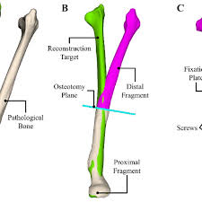 Bones in your body names. Overview Of State Of The Art Preoperative Planning Of Long Bone Download Scientific Diagram