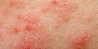 O tratamento pode envolver pomadas e medicamentos com aplicação direta na área atingida. Psoriase Gutata Causas Sintomas Tratamento Prognostico Diagnostico Exenin