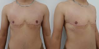 Image result for Mastectomy