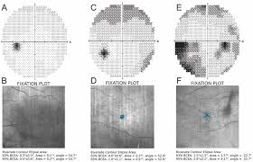 Image result for Visual Fixation