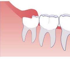 It can be difficult for someone to know whether their wisdom teeth need to be extracted. How Do I Know If I Have Wisdom Teeth