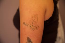 Laser Tattoo Removal Before And After The Untattoo Parlor Pain Free Tattoo Removal