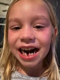 My little lady lost her first tooth today. Dad may have assisted a little  with final extraction but no pain and all smile!!