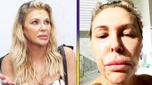 Former 'The Real Housewives of Beverly Hills' star Brandi Glanville says  she was left disfigured as the result of stress-induced angioedema.