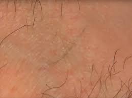 Ingrown armpit hair is common and harmless. The Best Ingrown Hair Removal Videos Insider