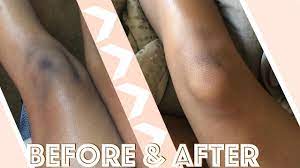 To lighten dark knees and elbows naturally at home, turn to the skin care favourites, lemon and honey. How I Lightened My Knees Elbows In 2 Weeks Fast Cheap Youtube