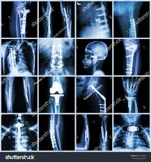 Collection X Ray Orthopedic Surgery Multiple Part Of Human Operate And Internal Fixation By Plate Orthopedic Surgery Orthopedics X Ray