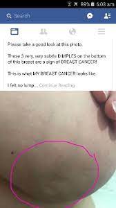 Also known as peau d'orange, dimpling of the breast causes the skin to look like the. Is Dimpling Always A Sign Of Breast Cancer How Lemons Can Help You Check For Breast Cancer Sheerluxe Com Other Than That I Have No Other Symptoms