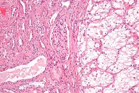 renal cell carcinoma wikipedia