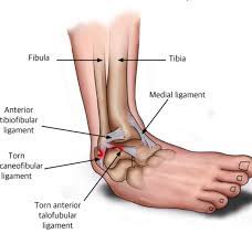 It is common to have swelling and bruising or a black and blue area under the ankle bone. if the sprain is bad enough, the bruising can extend into the toes and up the leg. Ankle Sprain Foot Ankle Experts