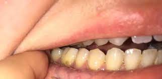 Sobald der verfall so weit fortgeschritten ist dass er das weichere gewebe des zahns erreicht in dem sich das dentin und die nerven befinden werden sie möglicherweise die ersten anzeichen des kariesbefalls spüren. Loch Am Zahn Zahne Zahnarzt