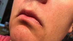 The most common factor that causes facial hair is hormonal imbalance. Excessive Facial Hair In Women And Polycystic Ovary Syndrome Pcos