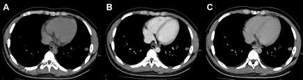 Thoracic— refers to the chest area. Characterization Of Solitary Pulmonary Nodules Use Of Washout Characteristics At Contrast Enhanced Computed Tomography