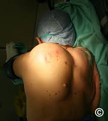 Image result for Liposarcoma