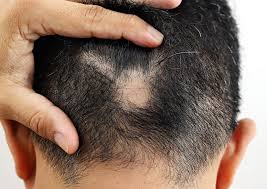 Hair loss from medication usually ceases once people stop taking the medication. Genetic Vs Reactive Male Hair Loss