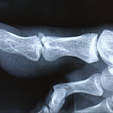 We did not find results for: Pdf Avulsion Fracture In Distal Phalanx Of Left Great Toe A Rare Unnoticed Karate Sports Injury